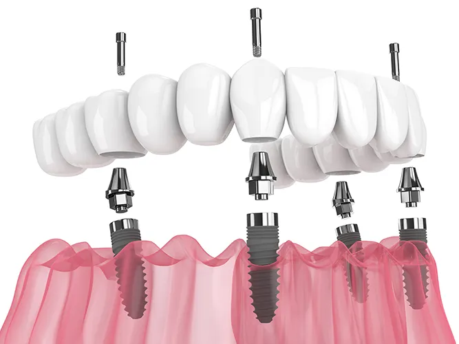 An illustration of how all on four implants work - Harmony Family Dentistry in Vancouver WA