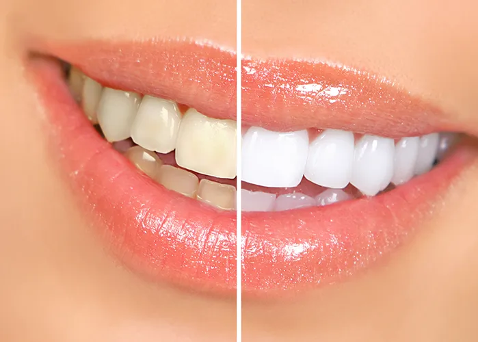 Teeth whitening before and after - Harmony Family Dentistry in Vancouver WA