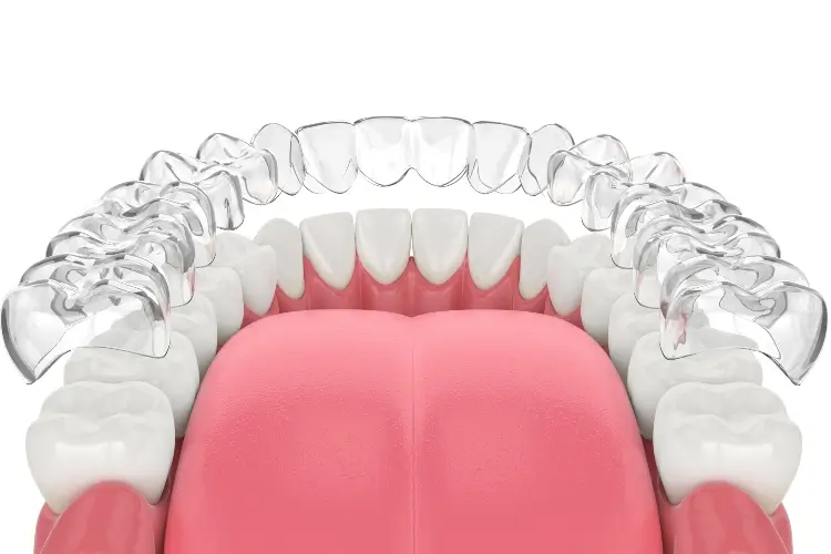 Invisalign® clear dental aligner shown over 3d model of vancouver washington patient’s lower jaw
