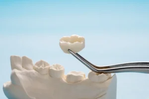 Closeup of a single tooth crown and bridge equipment model for tooth restoration