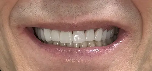 Bottom teeth after Bioclear treatment - Harmony Family Dentistry in Vancouver WA
