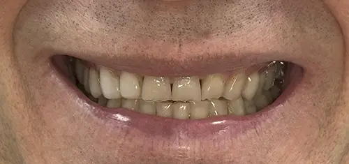 Bottom teeth before Bioclear treatment - Harmony Family Dentistry in Vancouver WA