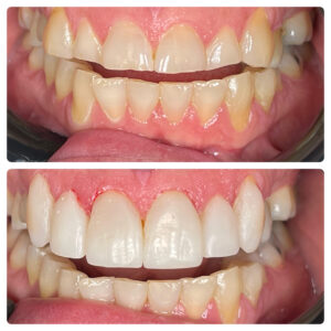 Before and after shots of veneers on a patient