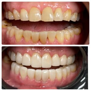 Before and after photos of Bioclear treatment on a patient
