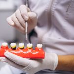 dental crowns in Vancouver
